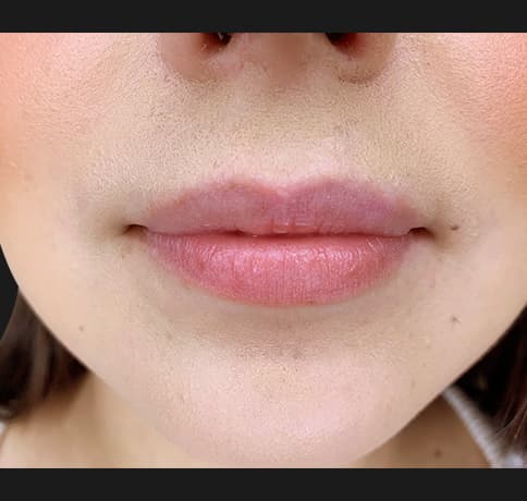 Case 46669, Performed By Dr. Tehrani – Before
