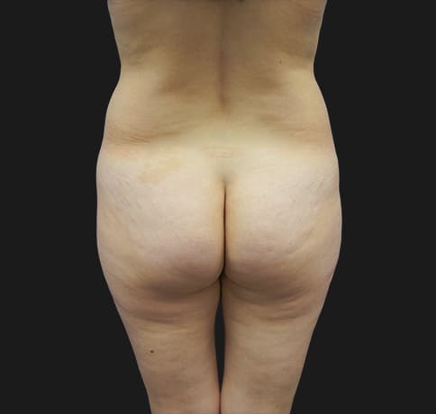Case 22943, Performed By Dr. Tehrani – Before