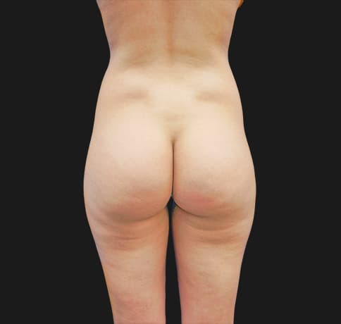 Case 29163, Performed By Dr. Tehrani – Before