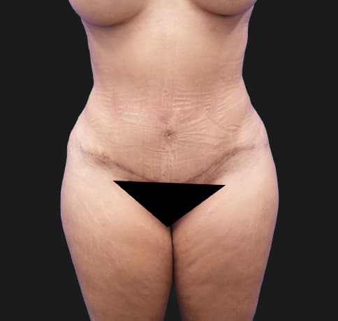 Case 30337, Performed By Dr. Tehrani – After