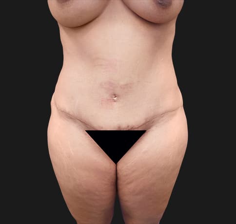 Case 30337, Performed By Dr. Tehrani – Before