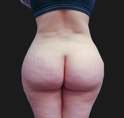 Case 38212, Performed By Dr. Tehrani – After