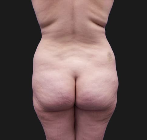 Case 38212, Performed By Dr. Tehrani – Before