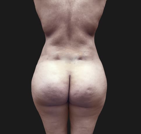 Case 41115, Performed By Dr. Tehrani – After