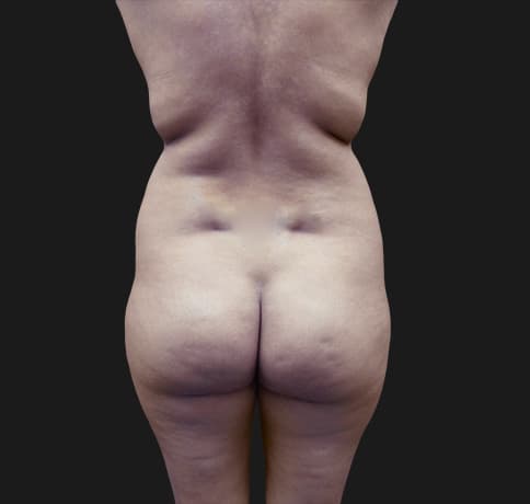 Case 41115, Performed By Dr. Tehrani – Before