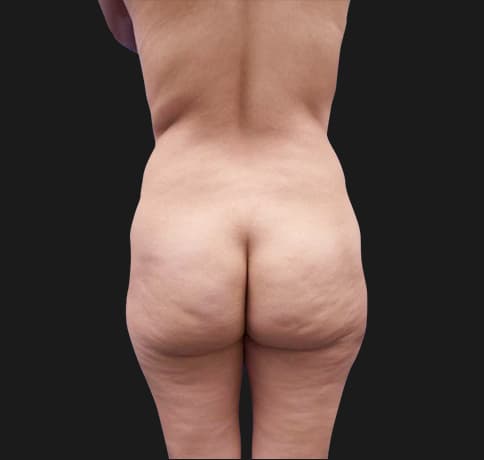 Case 20226, Performed By Dr. Tehrani – Before