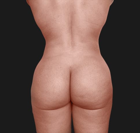 Case 40506, Performed By Dr. Tehrani – After