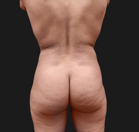 Case 40506, Performed By Dr. Tehrani – Before