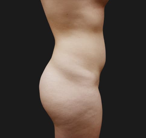 Case 342024, Performed By Dr. Tehrani – Before