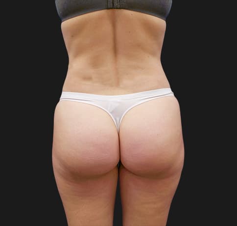 Case 41767, Performed By Dr. Tehrani – After