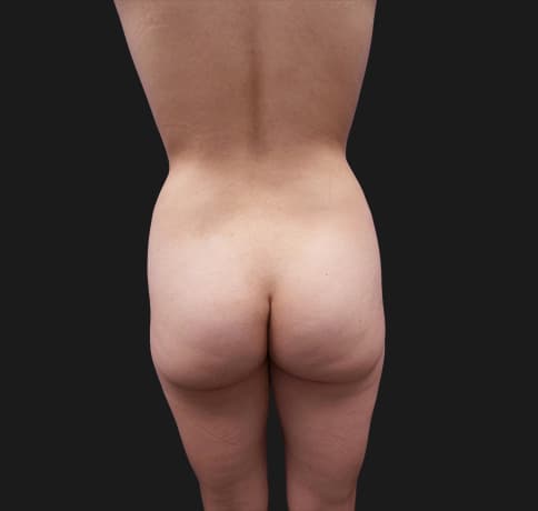 Case 42920, Performed By Dr. Tehrani – Before