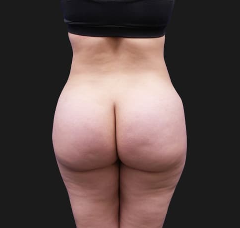 Case 43065, Performed By Dr. Tehrani – After