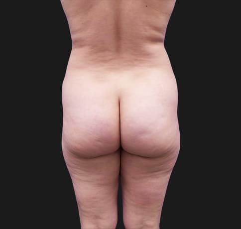 Case 43065, Performed By Dr. Tehrani – Before