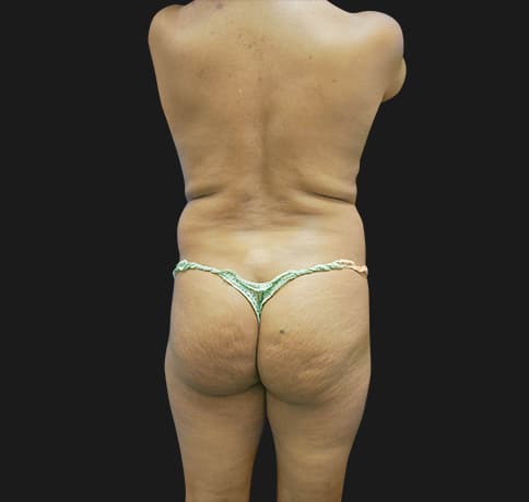 Case 15697, Performed By Dr. Tehrani – Before