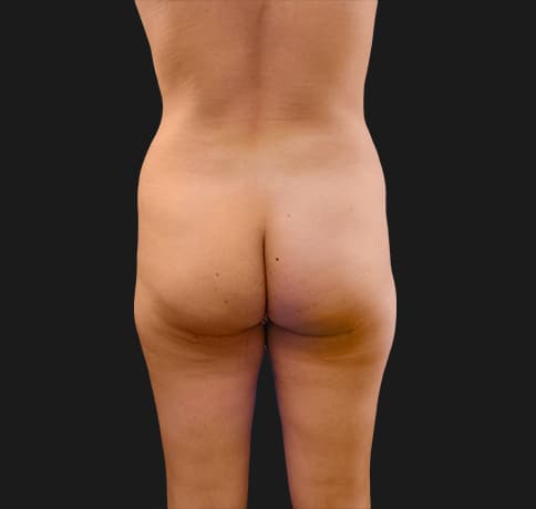 Case 16605, Performed By Dr. Tehrani – Before
