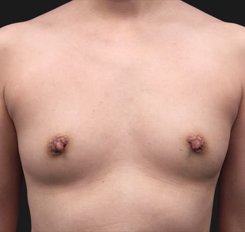 Case 33569, Performed By Dr. Tehrani – Before