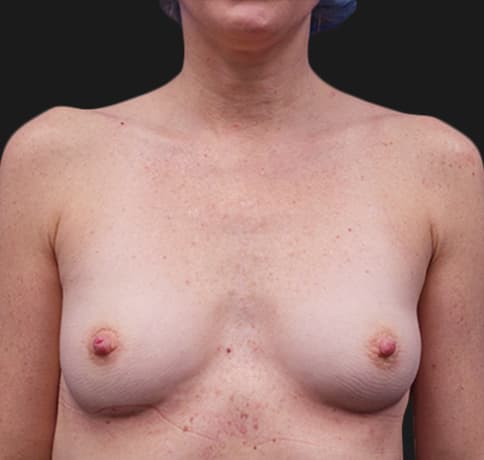 Case 32910, Performed By Dr. Tehrani – Before