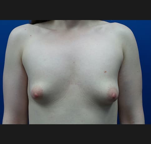 Case 33990, Performed By Dr. Tehrani – Before
