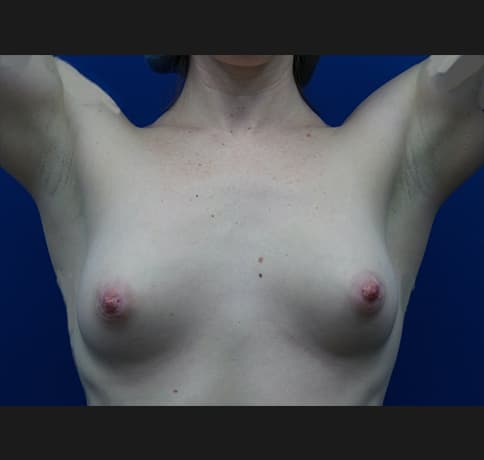 Case 31654, Performed By Dr. Tehrani – Before