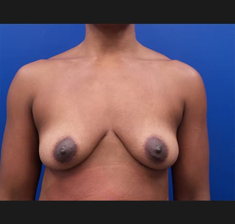 Case 34183, Performed By Dr. Tehrani – Before