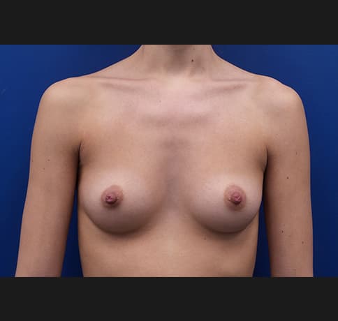 Case 35863, Performed By Dr. Tehrani – Before