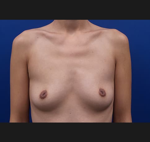 Case 35673, Performed By Dr. Tehrani – Before