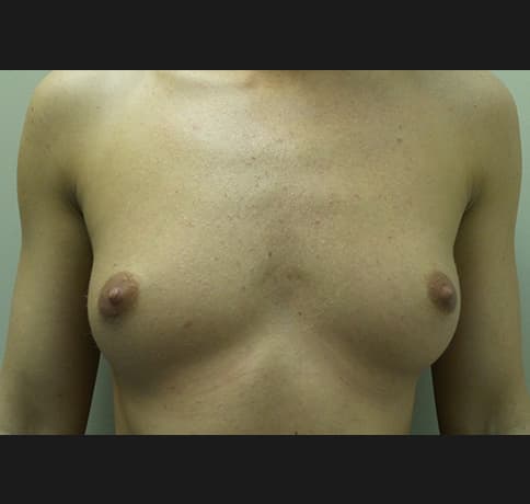 Case 32843, Performed By Dr. Tehrani – Before