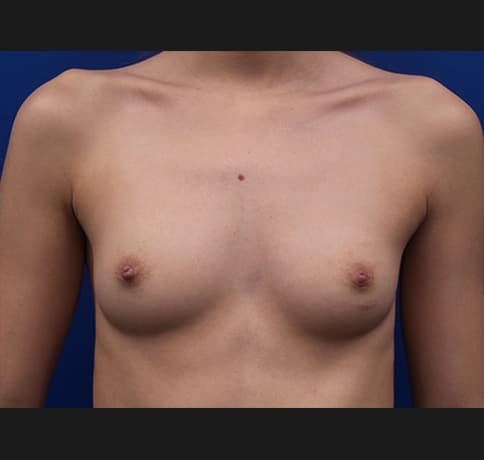 Case 36506, Performed By Dr. Tehrani – Before