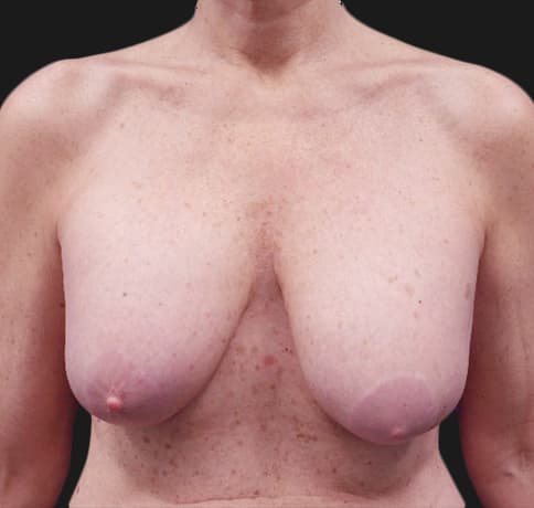 Case 36835 , Performed By Dr. Tehrani – Before