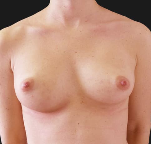 Case 36917, Performed By Dr. Tehrani – Before