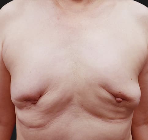 Case 38560 , Performed By Dr. Tehrani – Before