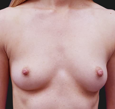 Case 38527 , Performed By Dr. Tehrani – Before