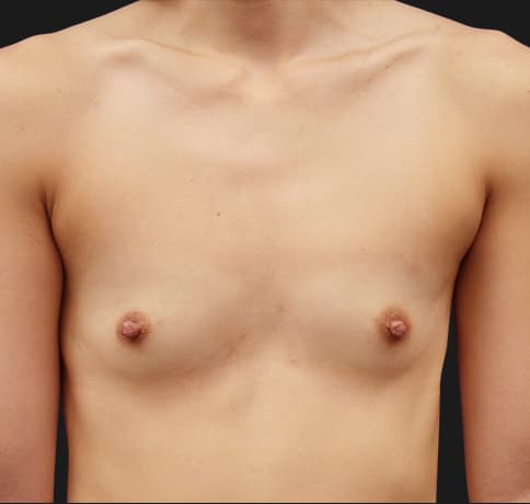 Case 39179 , Performed By Dr. Tehrani – Before