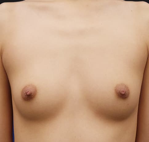 Case 39534, Performed By Dr. Tehrani – Before
