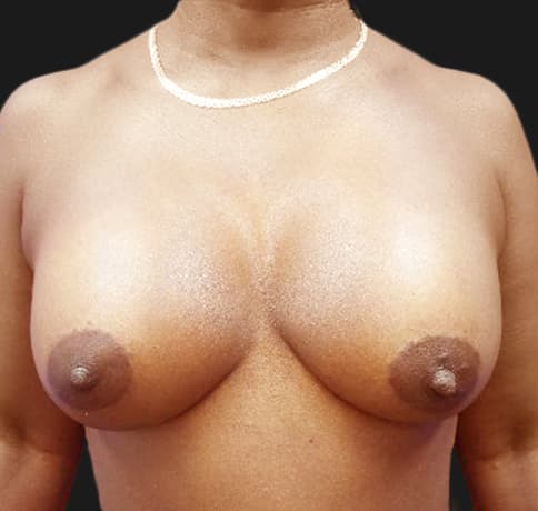 Case 34718, Performed By Dr. Tehrani – After