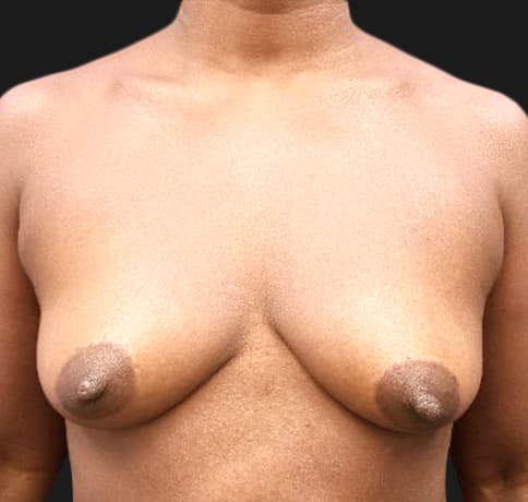 Case 34718, Performed By Dr. Tehrani – Before