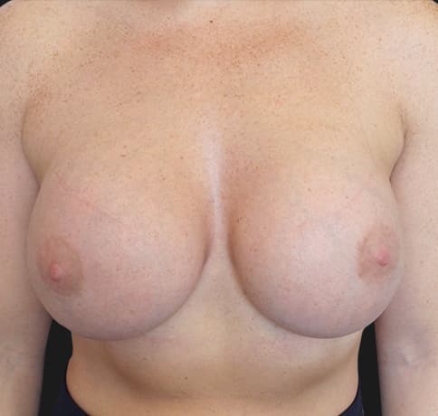 Case 33048, Performed By Dr. Tehrani – After