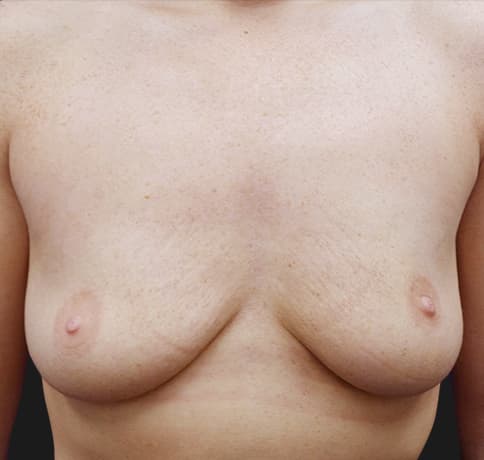 Case 33048, Performed By Dr. Tehrani – Before