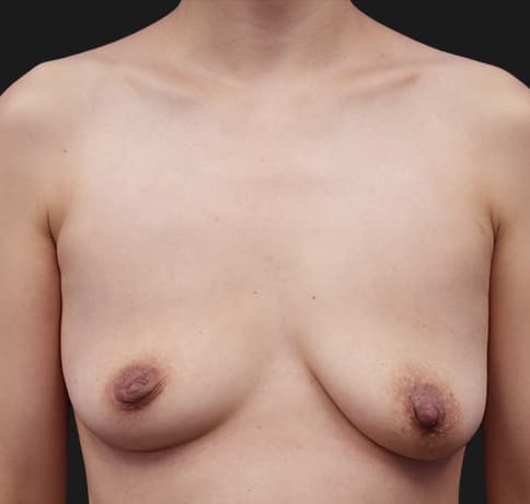 Case 43478, Performed By Dr. Tehrani – Before