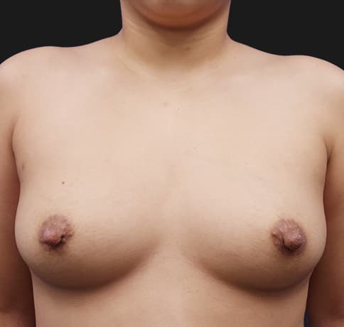 Case 43591, Performed By Dr. Tehrani – After