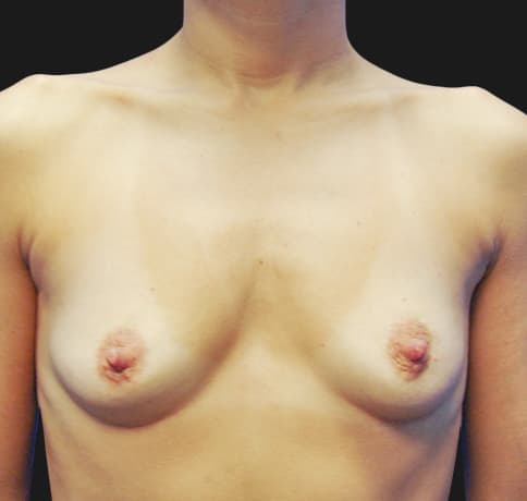 Case 12221, Performed By Dr. Tehrani – Before