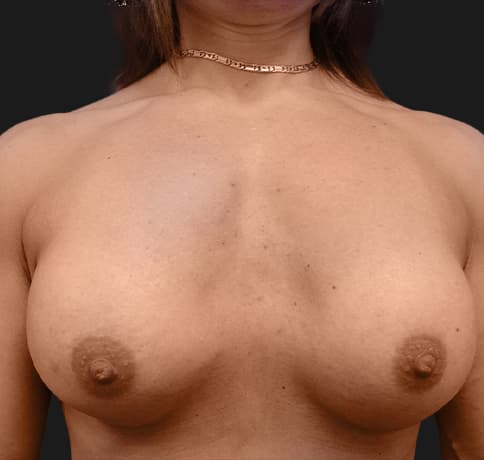 Case 9398, Performed By Dr. Tehrani – After