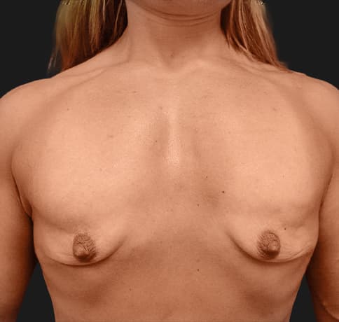 Case 9398, Performed By Dr. Tehrani – Before