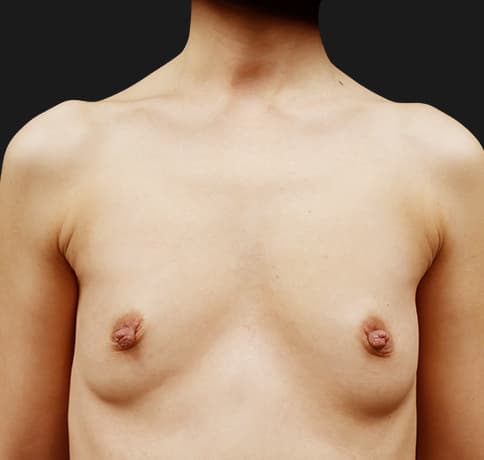 Case 54590, Performed By Dr. Tehrani – Before