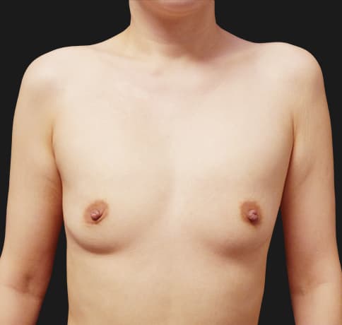 Case 56083, Performed By Dr. Tehrani – Before