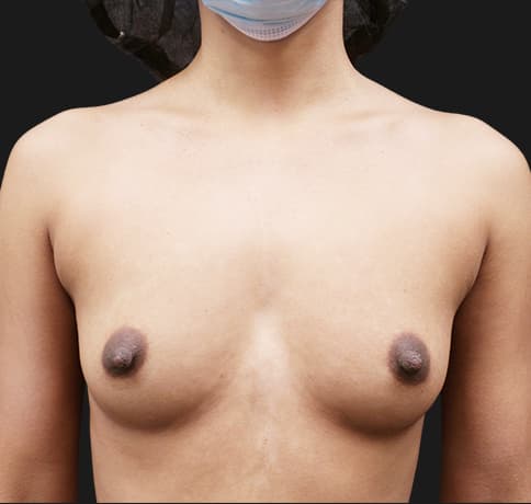 Case 56518, Performed By Dr. Tehrani – Before