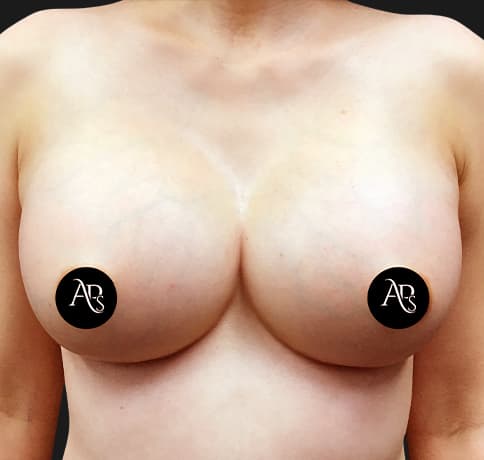 Case 60268, Performed By Dr. Tehrani – After