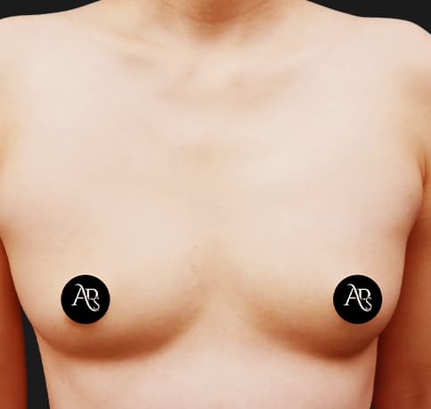 Case 60268, Performed By Dr. Tehrani – Before