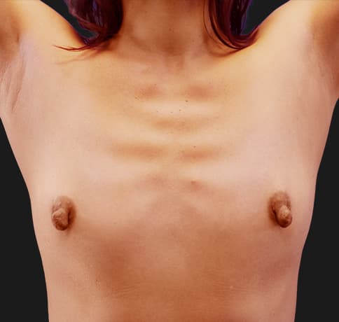 Case 1000, Performed By Dr. Tehrani – Before