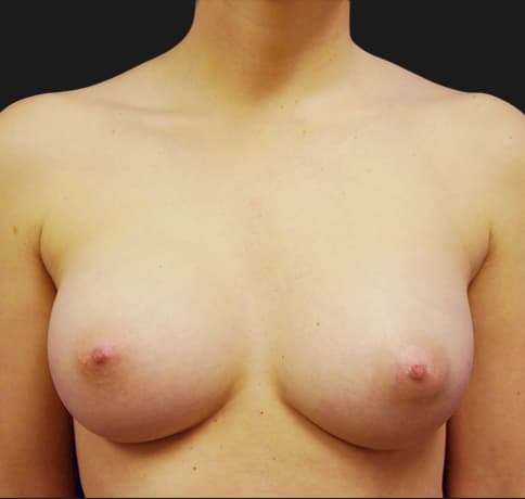 Case 19360, Performed By Dr. Tehrani – After